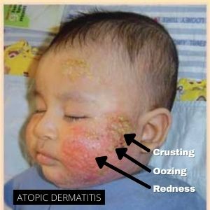 Sign and symptoms of Atopic Dermatitis